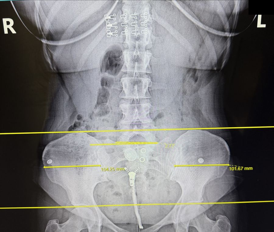 Front view low back X-ray at PATH Chiropractic showing hip height measured