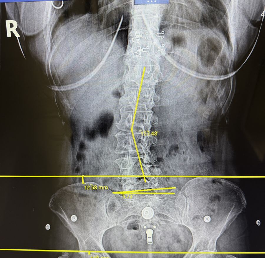 Low back X-ray showing a curve