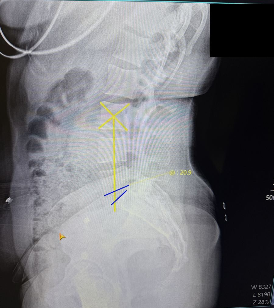 Side view low back X-ray at PATH Chiropractic showing lumbar curve analysis