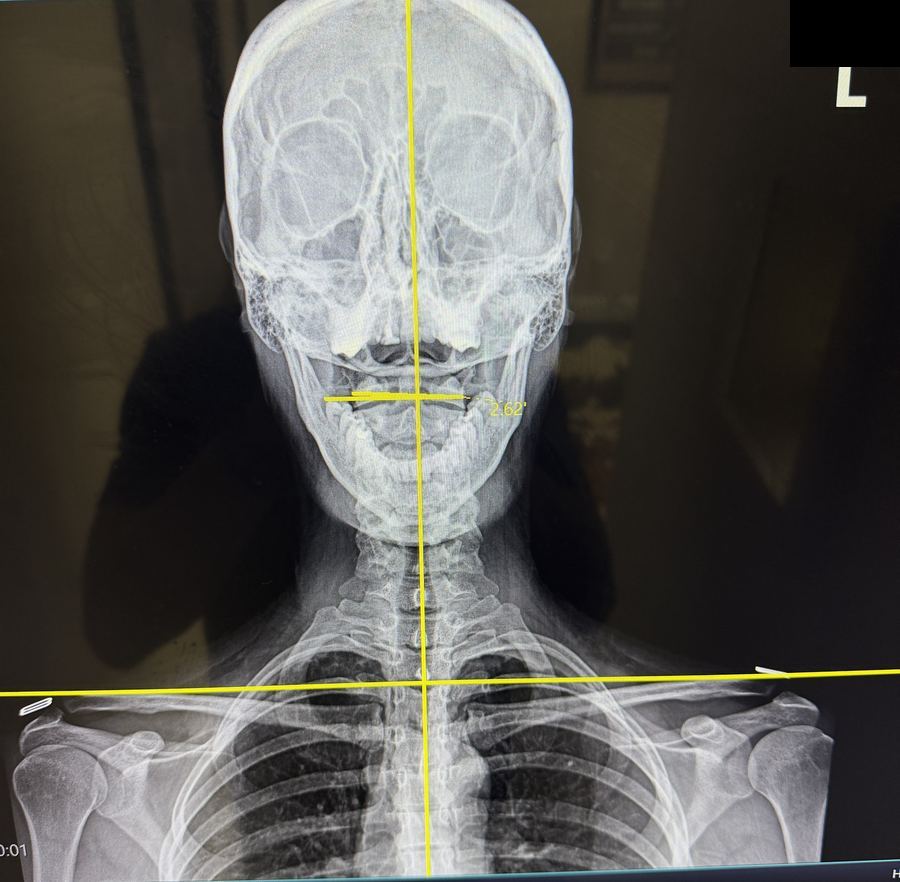 Front view neck and head X-ray with alignment lines