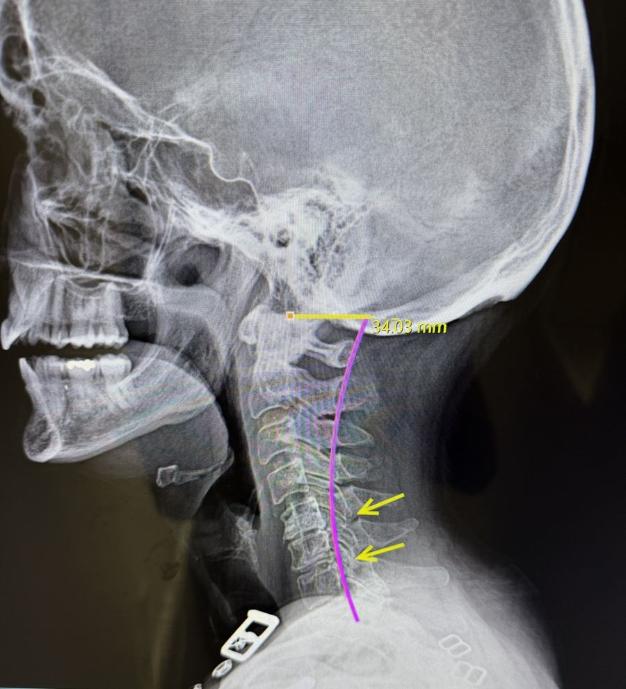 Side view neck X-ray with curve measurement
